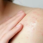 ユーグレナ×麻布大学、デオキシニバレノールによる皮膚アレルギー軽減効果の発見